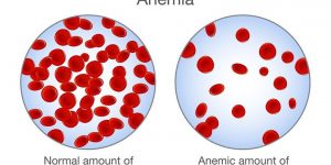 Penyakit & Kondisi : Anemia Aplastik