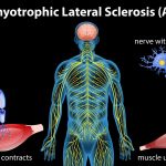 Penyakit Lou Gehrig Amyotrophic lateral sclerosis (ALS)